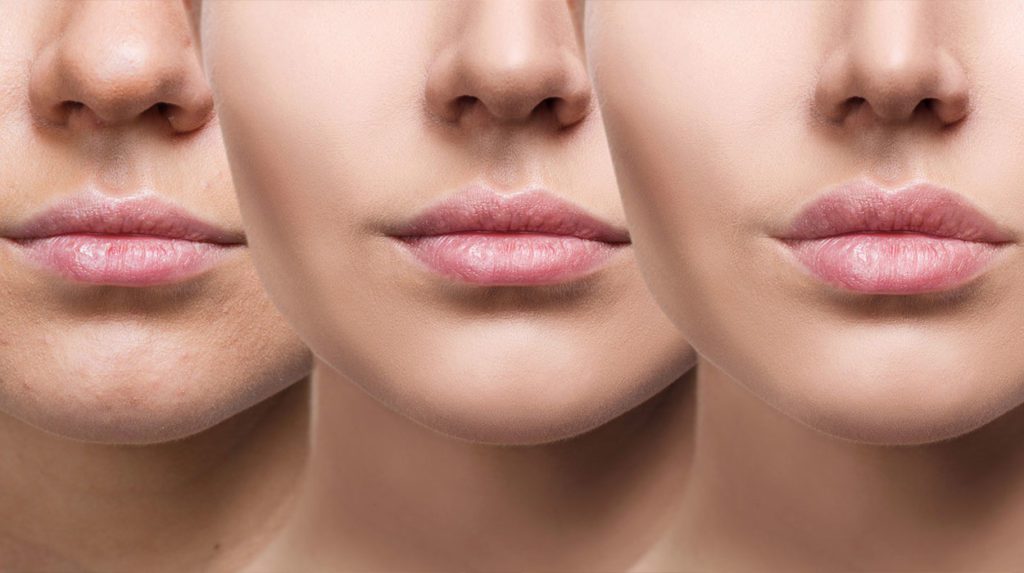 Dermal Fillers