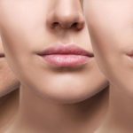 Dermal Fillers