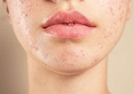 136901714-teenage-girl-with-acne-problem-on-beige-background-closeup