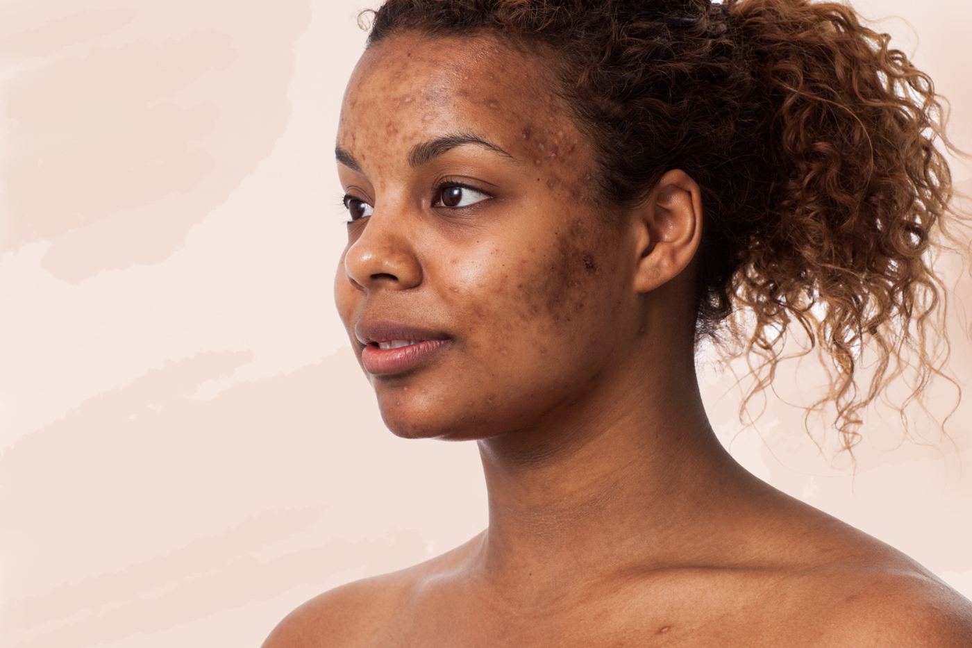 dark-skin-hyperpigmentation-treatment
