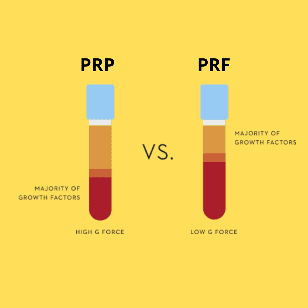 PRF vs PRP