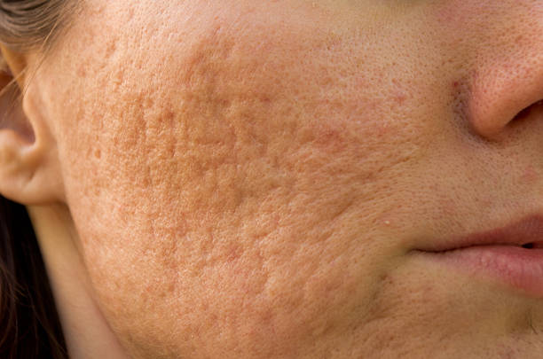 acne-scarring-treatment-liverpool